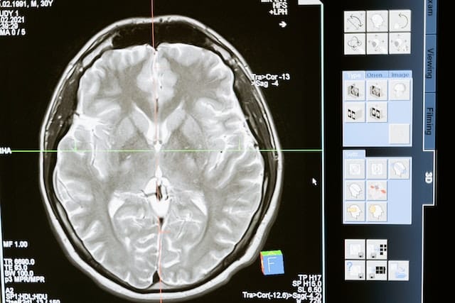 Neuralink Ottiene l’Approvazione per i Test degli Impianti Cerebrali